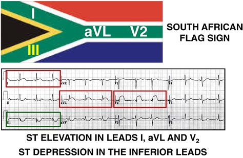 south african flag sign ecg